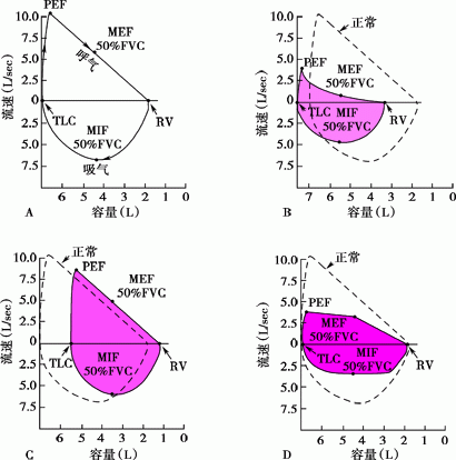 什么是气体陷闭难！温故未必能知新——肺通气_https://www.jmylbn.com_新闻资讯_第23张