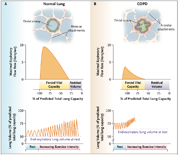 什么是气体陷闭难！温故未必能知新——肺通气_https://www.jmylbn.com_新闻资讯_第37张