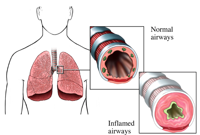 什么是气体陷闭难！温故未必能知新——肺通气_https://www.jmylbn.com_新闻资讯_第31张