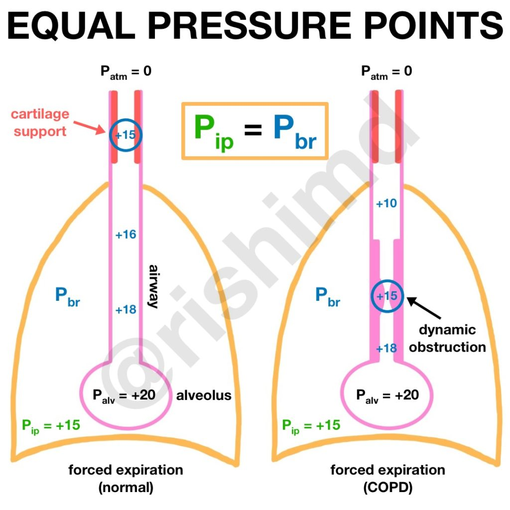什么是气体陷闭难！温故未必能知新——肺通气_https://www.jmylbn.com_新闻资讯_第24张