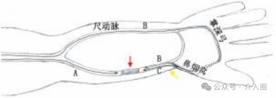 穿刺鞘英文怎么写桡动脉闭塞的开通方法_https://www.jmylbn.com_新闻资讯_第4张