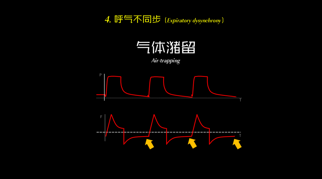 为什么呼吸机人机同步【涨知识】呼吸机人机不同步识别和处理_https://www.jmylbn.com_新闻资讯_第6张
