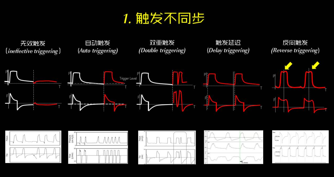 为什么呼吸机人机同步【涨知识】呼吸机人机不同步识别和处理_https://www.jmylbn.com_新闻资讯_第3张