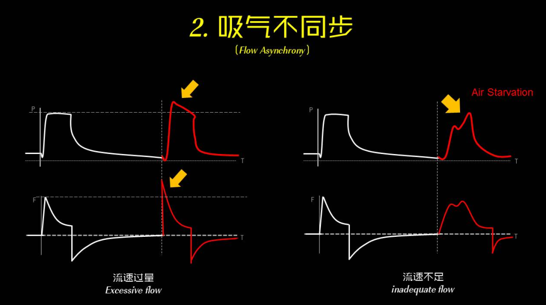 为什么呼吸机人机同步【涨知识】呼吸机人机不同步识别和处理_https://www.jmylbn.com_新闻资讯_第4张