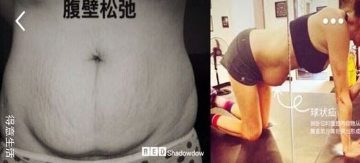 产后大肚腩——腹直肌分离