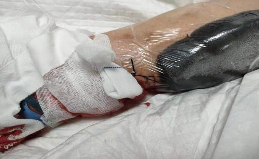 为什么负压引流什么是负压封闭引流技术？有何特点？_https://www.jmylbn.com_新闻资讯_第2张