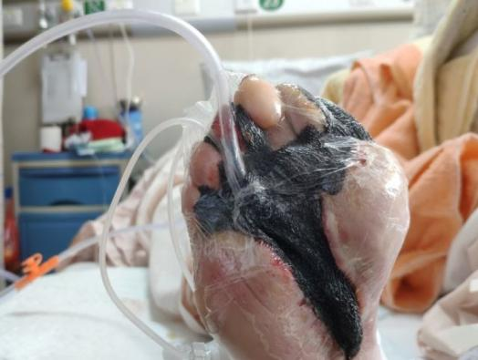 为什么负压引流什么是负压封闭引流技术？有何特点？_https://www.jmylbn.com_新闻资讯_第4张