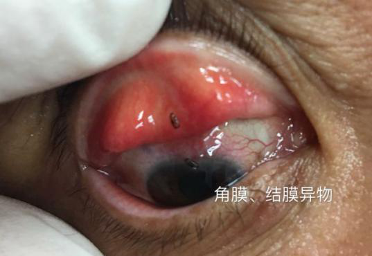 里,力度较大,或揉得太猛,物质嵌在角膜上出不来,出现眼红,疼痛,异物感