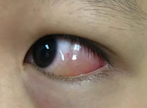 荔枝蝽尿液入眼睛后出现结膜水肿现场应对:用干净水源冲洗眼睛至少