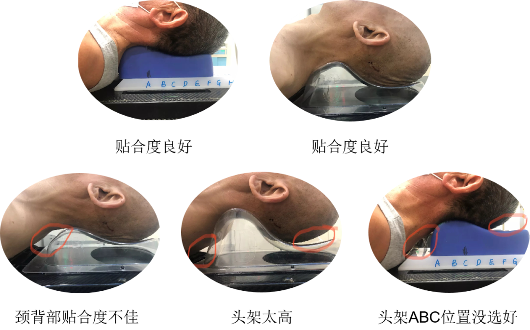 放疗做膜是什么意思一文图解｜放疗前需要做哪些准备工作？_https://www.jmylbn.com_新闻资讯_第9张