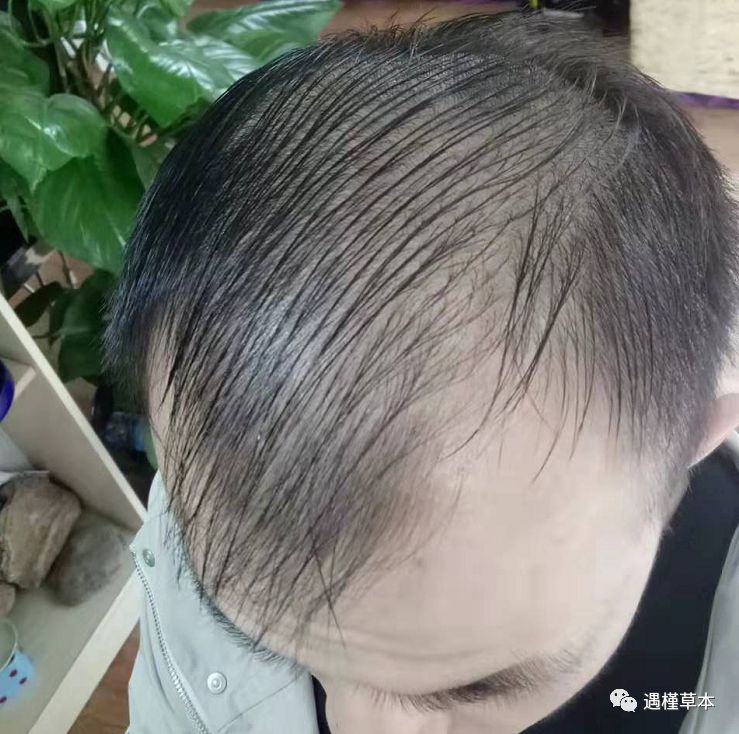 为什么我的头发油-掉发多-他的干？