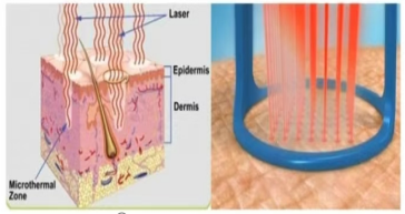 二氧化碳(co2)激光治疗是什么【人民医院】最新引进！CO2点阵激光治疗，解决妇科“难言之隐”！_https://www.jmylbn.com_新闻资讯_第5张