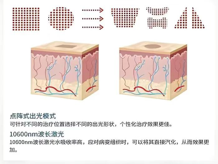 二氧化碳(co2)激光治疗是什么【人民医院】最新引进！CO2点阵激光治疗，解决妇科“难言之隐”！_https://www.jmylbn.com_新闻资讯_第6张