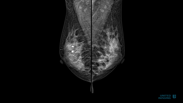 乳腺dr能检查什么盘州市第二人民医院引进国内一流乳腺DR机_https://www.jmylbn.com_新闻资讯_第10张