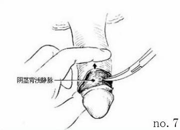 包皮自动切除环怎么用“揭秘包皮环切手术：全程详解，原来这么简单!＂_https://www.jmylbn.com_新闻资讯_第9张