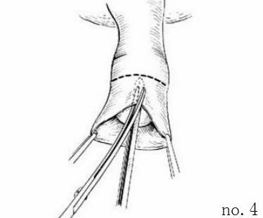 包皮自动切除环怎么用“揭秘包皮环切手术：全程详解，原来这么简单!＂_https://www.jmylbn.com_新闻资讯_第6张