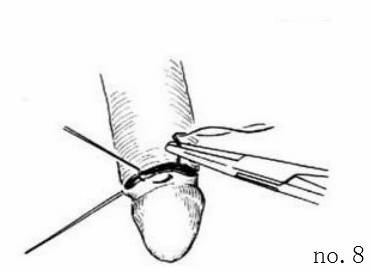 包皮自动切除环怎么用“揭秘包皮环切手术：全程详解，原来这么简单!＂_https://www.jmylbn.com_新闻资讯_第10张