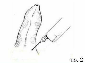 包皮自动切除环怎么用“揭秘包皮环切手术：全程详解，原来这么简单!＂_https://www.jmylbn.com_新闻资讯_第4张