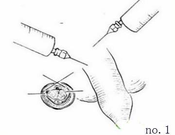 包皮自动切除环怎么用“揭秘包皮环切手术：全程详解，原来这么简单!＂_https://www.jmylbn.com_新闻资讯_第3张