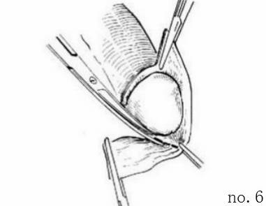 包皮自动切除环怎么用“揭秘包皮环切手术：全程详解，原来这么简单!＂_https://www.jmylbn.com_新闻资讯_第8张