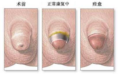 包皮自动切除环怎么用“揭秘包皮环切手术：全程详解，原来这么简单!＂_https://www.jmylbn.com_新闻资讯_第12张