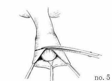 包皮自动切除环怎么用包皮手术全过程讲解，包皮环切手术其实很简单！_https://www.jmylbn.com_新闻资讯_第8张
