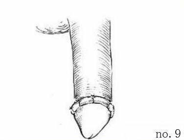 包皮自动切除环怎么用“揭秘包皮环切手术：全程详解，原来这么简单!＂_https://www.jmylbn.com_新闻资讯_第11张