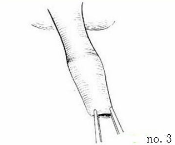 包皮自动切除环怎么用包皮手术全过程讲解，包皮环切手术其实很简单！_https://www.jmylbn.com_新闻资讯_第6张