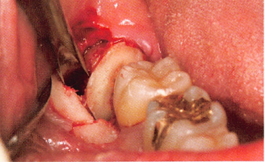 用这种药，拔牙要小心？