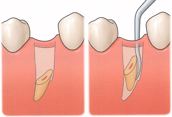 注意牙挺拔牙的技巧，千万别踩雷！