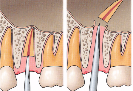 注意牙挺拔牙的技巧，千万别踩雷！