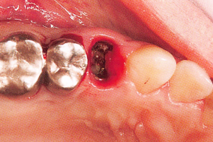 注意牙挺拔牙的技巧，千万别踩雷！