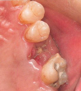 注意牙挺拔牙的技巧，千万别踩雷！