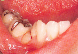 注意牙挺拔牙的技巧，千万别踩雷！