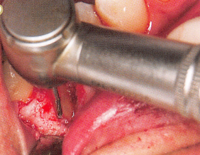 注意牙挺拔牙的技巧，千万别踩雷！