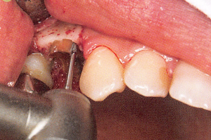 注意牙挺拔牙的技巧，千万别踩雷！