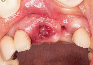 注意牙挺拔牙的技巧，千万别踩雷！