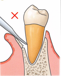 注意牙挺拔牙的技巧，千万别踩雷！