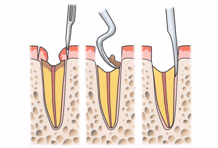 注意牙挺拔牙的技巧，千万别踩雷！