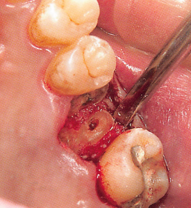 注意牙挺拔牙的技巧，千万别踩雷！