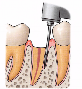 注意牙挺拔牙的技巧，千万别踩雷！