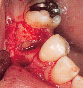注意牙挺拔牙的技巧，千万别踩雷！