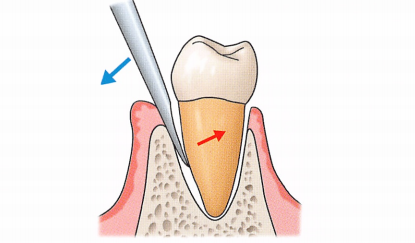 注意牙挺拔牙的技巧，千万别踩雷！