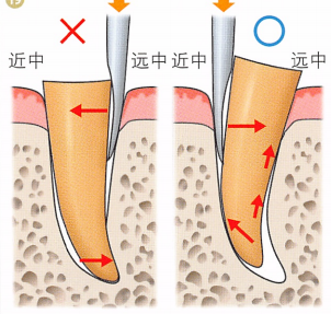 注意牙挺拔牙的技巧，千万别踩雷！