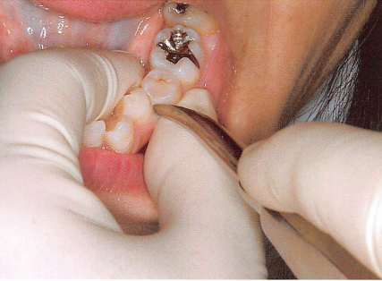 注意牙挺拔牙的技巧，千万别踩雷！