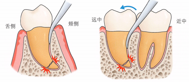 注意牙挺拔牙的技巧，千万别踩雷！