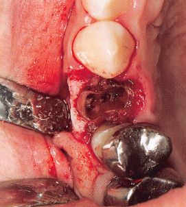 注意牙挺拔牙的技巧，千万别踩雷！