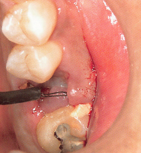 注意牙挺拔牙的技巧，千万别踩雷！