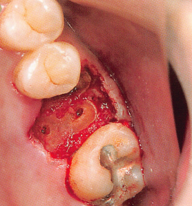 注意牙挺拔牙的技巧，千万别踩雷！