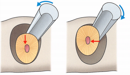 注意牙挺拔牙的技巧，千万别踩雷！